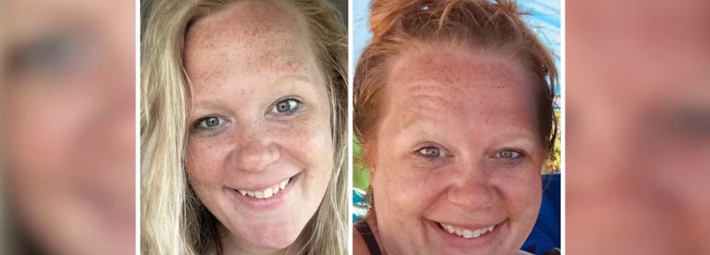 Katie’s Journey – What It’s Like 3 Months After Weight Loss Surgery