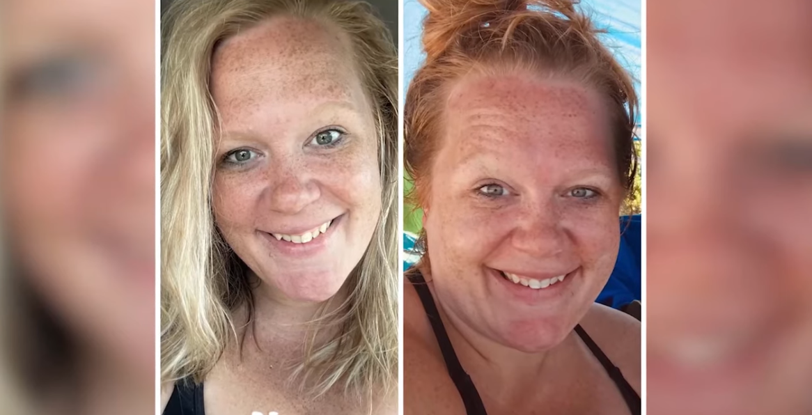 Katie’s Journey – What It’s Like 3 Months After Weight Loss Surgery