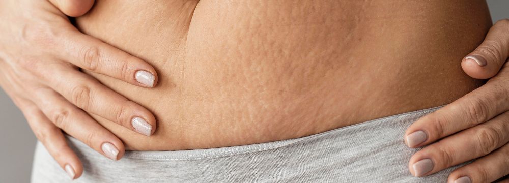 What Will Happen to My Skin After Weight Loss Surgery?