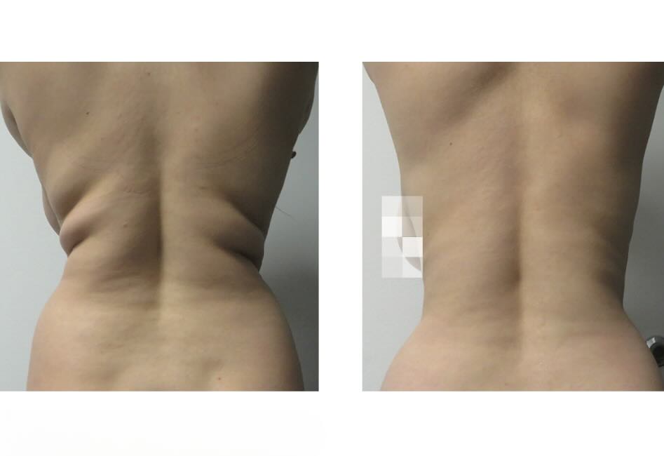 >Melt Away the Fat